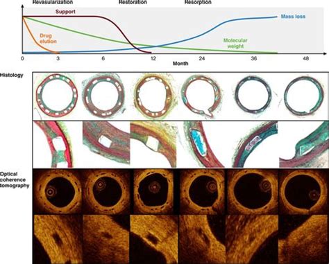 Polycaprolactone: Exploring its Use in Bioresorbable Stents and Tissue Engineering Scaffolds!